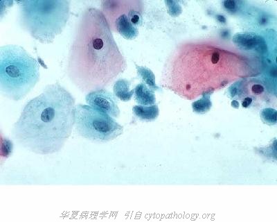 宫颈病原微生物感染:滴虫性阴道炎