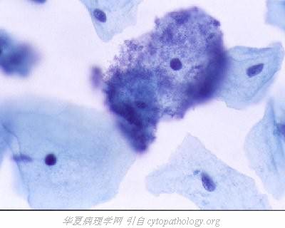 宫颈病原微生物感染:线索细胞 - 日志 - 学海无涯 温都博客 - 温州博客网