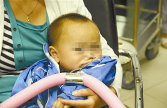 金属挂钩贯穿2龄童口鼻